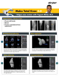 Mako Total Knee 2.0 Valgus case review with Yogesh Mittal M.D.