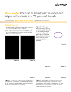 Use of EasyFuse in extended triple arthrodesis 72 year-old female