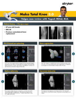 Mako Total Knee 2.0 – Valgus case review with Yogesh Mittal, M.D.